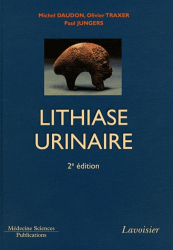 La lithiase urinaire