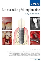 Extraction dentaire atraumatique - Cabinet Parodontie Paris 11