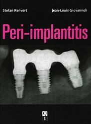 En promotion de la Editions quintessence publishing : Promotions de l'éditeur, Peri-implantitis