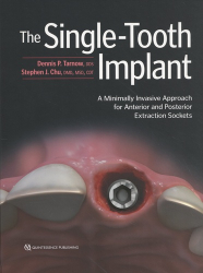 The Single-Tooth Implant